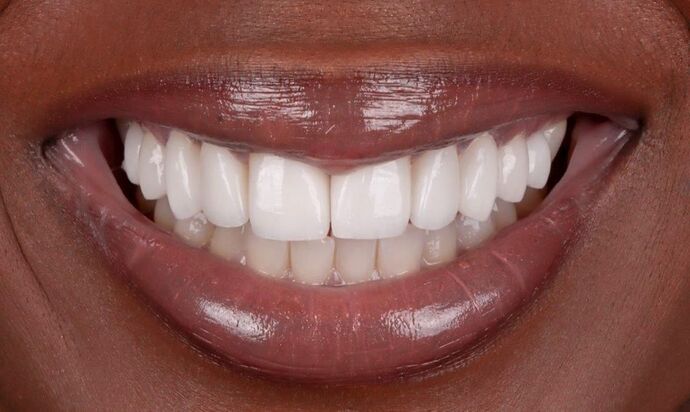 Dr. Wayne Myles' patient after veneers